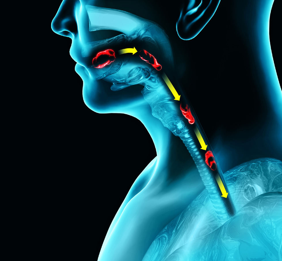 Esophageal Conditions